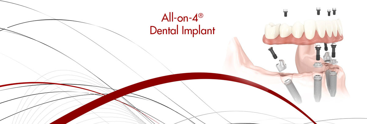Grayslake All-on-4 Dental Implants