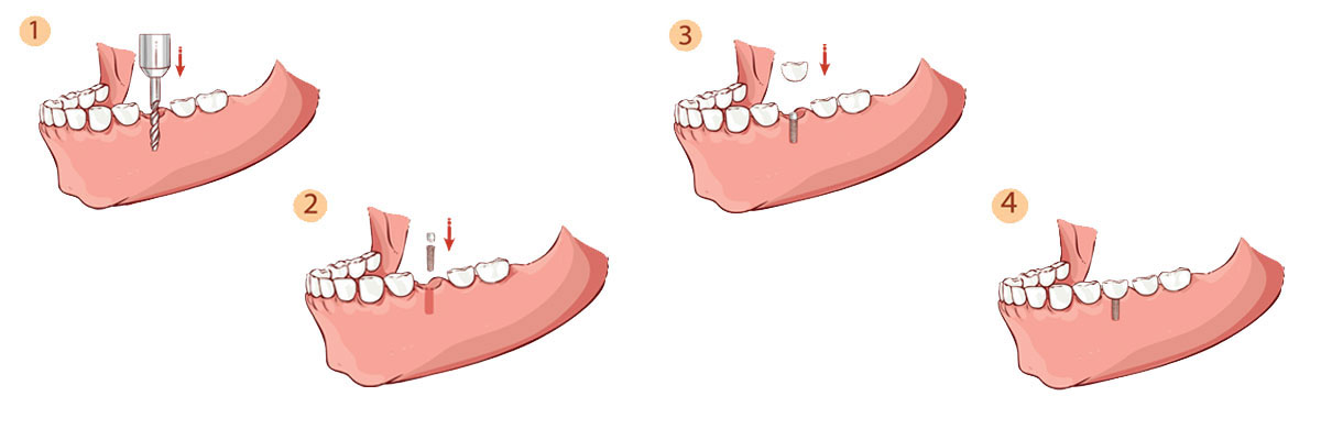 Grayslake Dental Implant Restoration