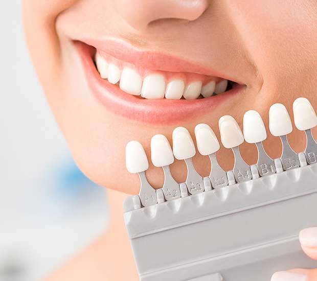 Grayslake Dental Veneers and Dental Laminates