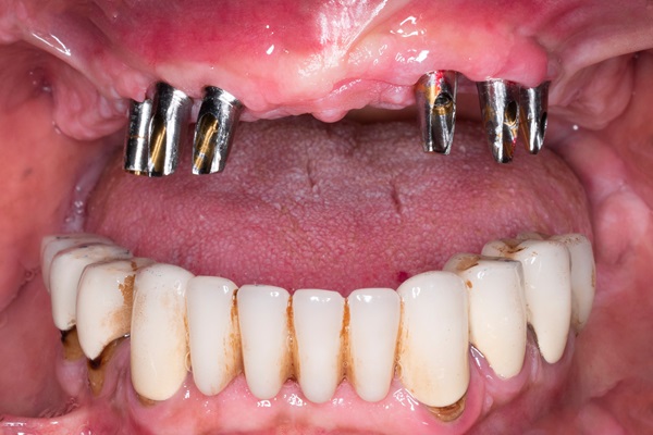 Recovery Guide After Full Mouth Reconstruction