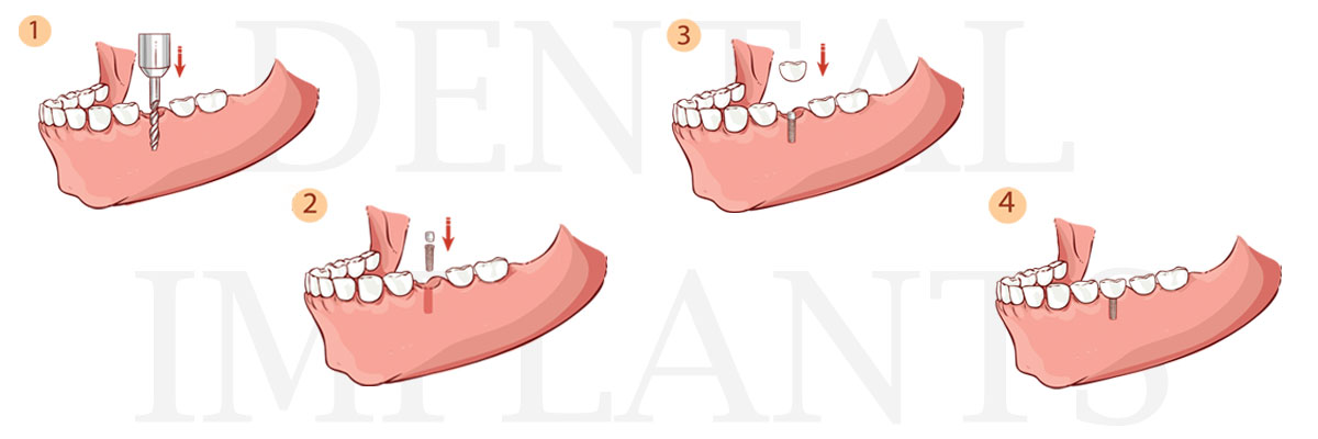 Grayslake The Difference Between Dental Implants and Mini Dental Implants