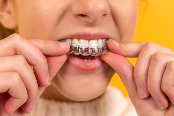 Questions To Ask An Invisalign Dentist