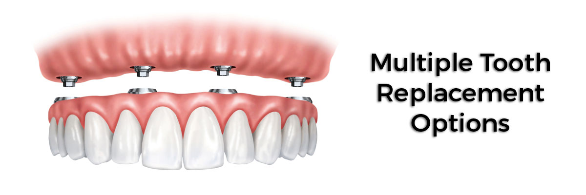 Grayslake Multiple Teeth Replacement Options
