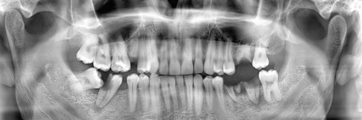 Grayslake Options for Replacing Missing Teeth