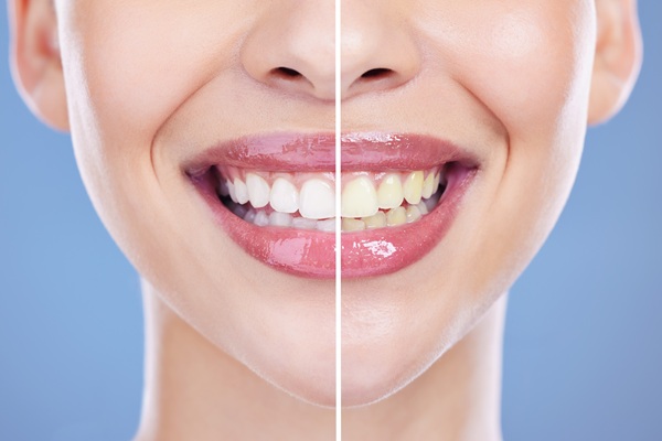 Am I A Candidate For Teeth Whitening If I Have Sensitive Teeth?